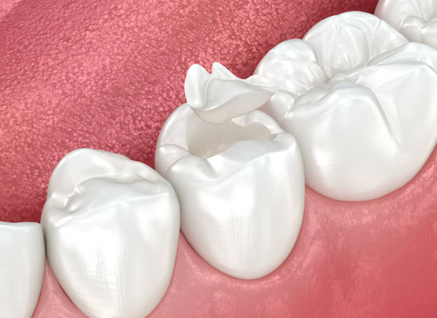 Best Dental Fillings (Composite and Amalgam)  in Hill N Dale, FL